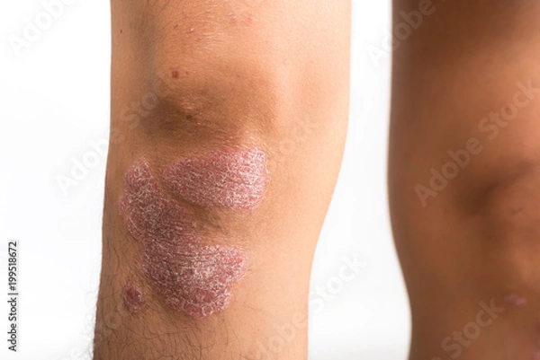 Fototapeta Psoriasis that knee on white background