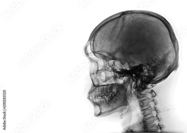 Fototapeta X-ray image of side view asian skull black and white