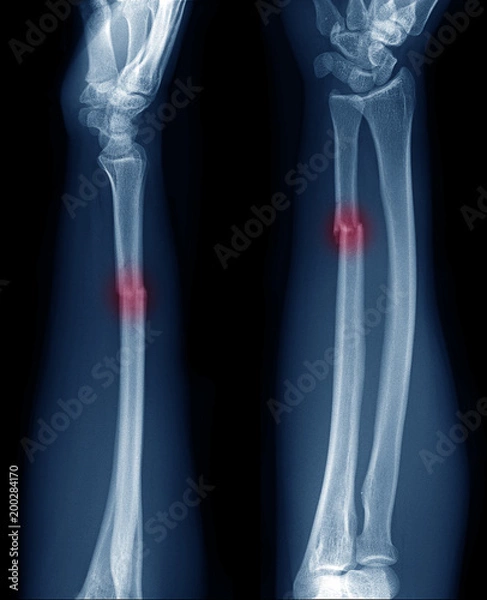 Fototapeta x-ray image show fracture of ulnar bone in arm at red area mark