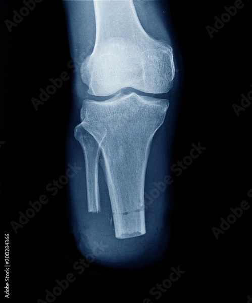 Fototapeta x-ray image of leg amputation front view