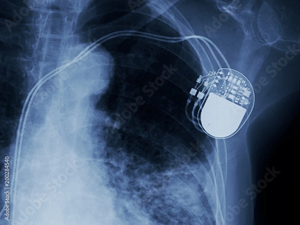 Fototapeta x-ray image of permanent pacemaker implant in chest body , process in blue tone