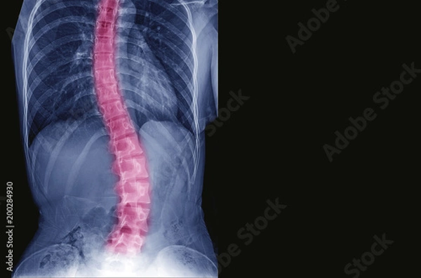 Fototapeta X-ray image of teenager patient spine show Scoliosis and spinal bend in young people. Process in blue tone spine mark in red color and have copy space, Medical concept.