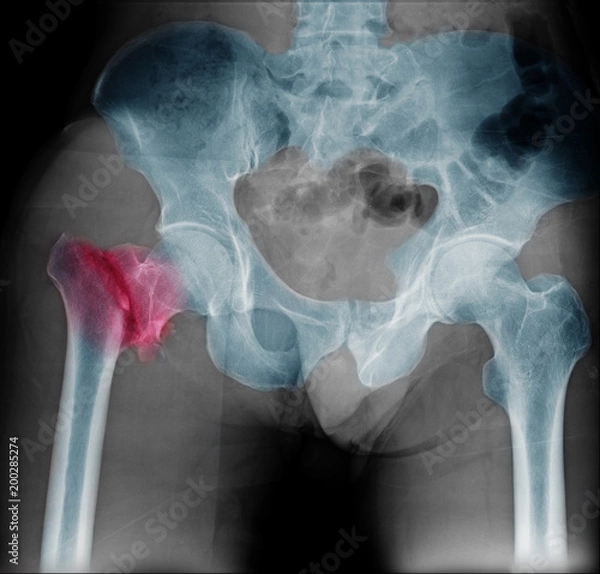 Fototapeta Hip fracture xray photo image. X-ray of hip joint for elderly patient who falling in the house. Bone process to blue tone and fracture area marked in red color.