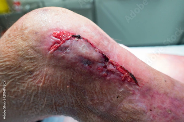 Fototapeta Leg wound on a senior man