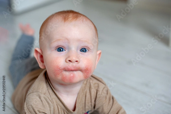 Fototapeta Traces of diathesis, allergies on baby's cheeks