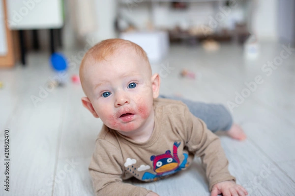 Fototapeta Traces of diathesis, allergies on baby's cheeks