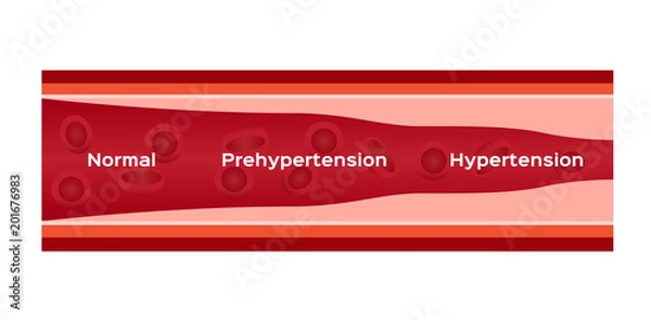 Obraz hypertension , high blood pressure vector / human anatomy