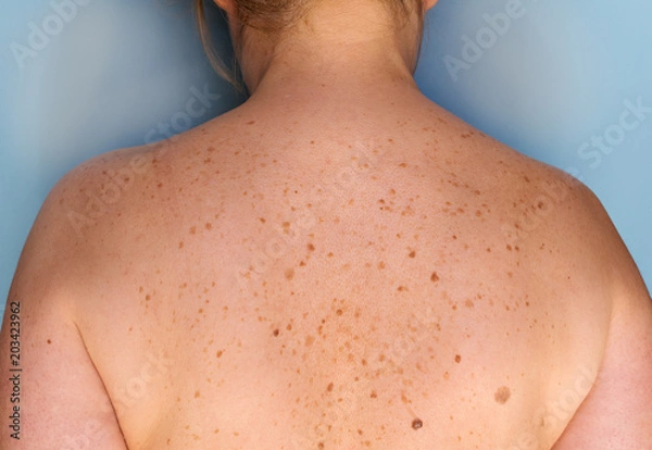 Obraz Closeup of freckles on back of a woman. Pigmentation and lot of birthmarks. Skin problems