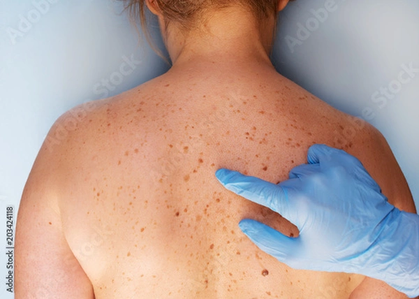 Obraz Dermatologist examining the patient in the clinic. problem skin with birthmarks. closeup