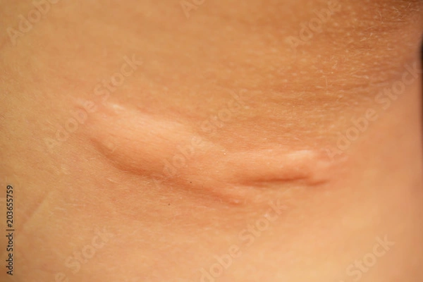 Fototapeta post-acne, scars and red festering pimples on the skin of the face. concept of skin problems and harmonic failure