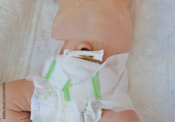 Obraz pępek noworodka