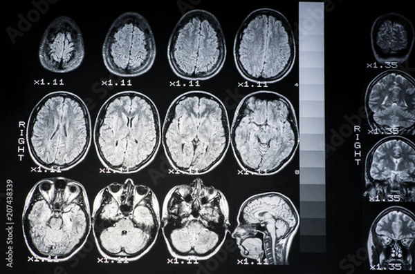 Obraz The result of MRI of the brain of a healthy person with a gray backlight. The longitudinal section of the brain. .