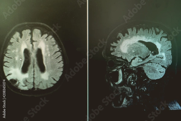 Obraz AD with CVD  white matter change