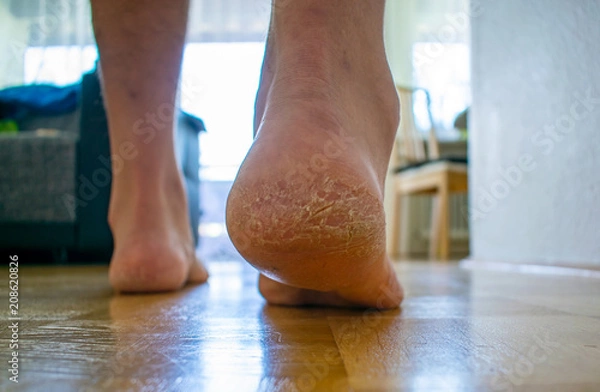 Obraz Schrunden am Männlichen Fuß