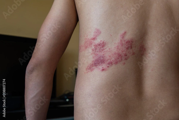 Obraz zamknij się na półpasiec z tyłu