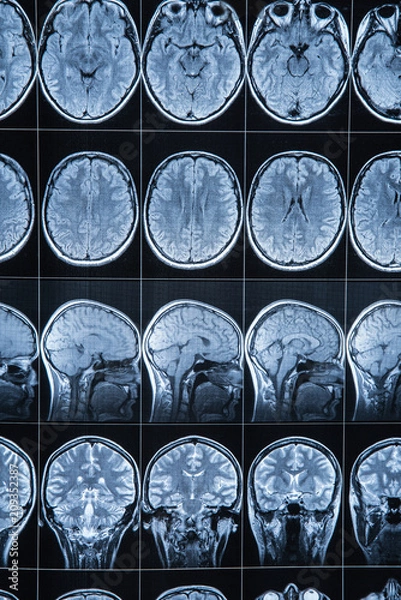 Obraz Magnetic resonance imaging of the head and brain, MRI