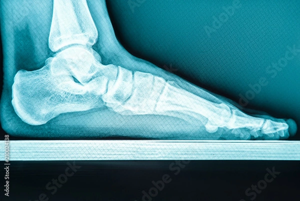 Obraz X-ray human foot with flatfoot