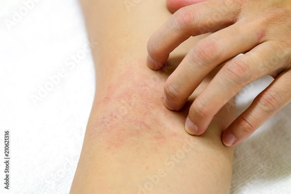 Fototapeta Women's hands are scratching allergy to red rash on white background