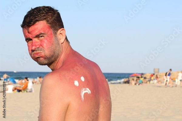 Obraz Mężczyzna dostaje oparzenie słoneczne na plaży