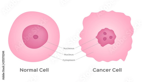 Fototapeta cancer cell stage and development vector