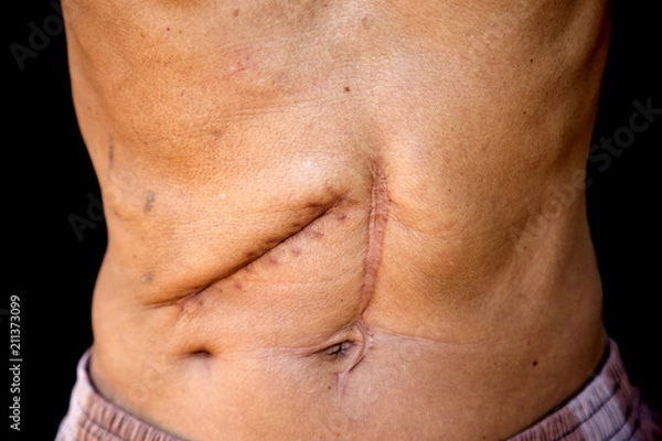 Obraz Scars caused by abdominal surgery.