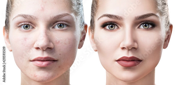 Obraz Woman with acne before and after treatment and make-up.