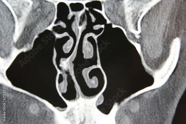 Obraz deviated septum
