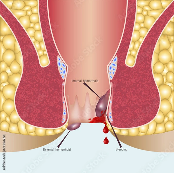 Obraz Internal hemorrhoids and external hemorrhoids