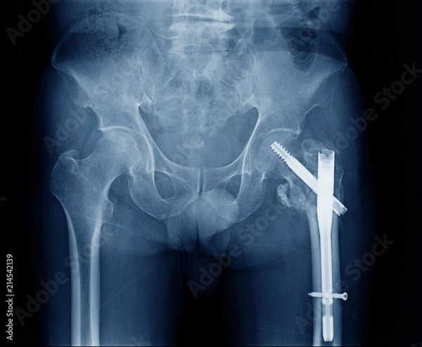 Fototapeta X-ray image of left side human hip fracture neck of femur bone. Open Reduction Internal Fixation with internal bone rod and screw by Orthopedic surgeon