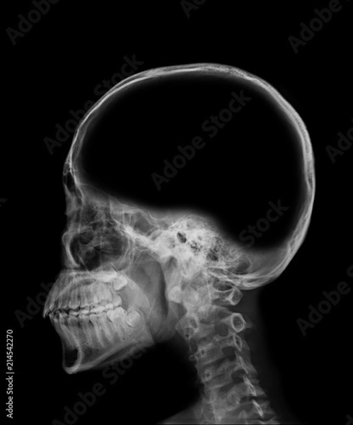 Fototapeta x-ray image of skull with blank area at brain , empty space in head , conceptual image of a open minded , can add text or object at brain area
