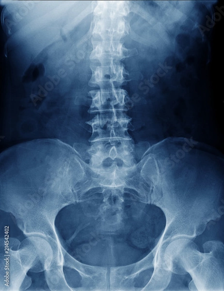 Fototapeta x-ray image of human normal spine, rips, pelvis, both hip joint