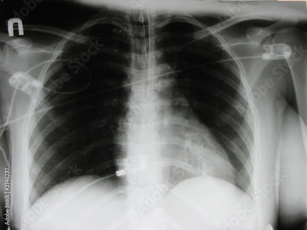 Fototapeta an xray of a chest