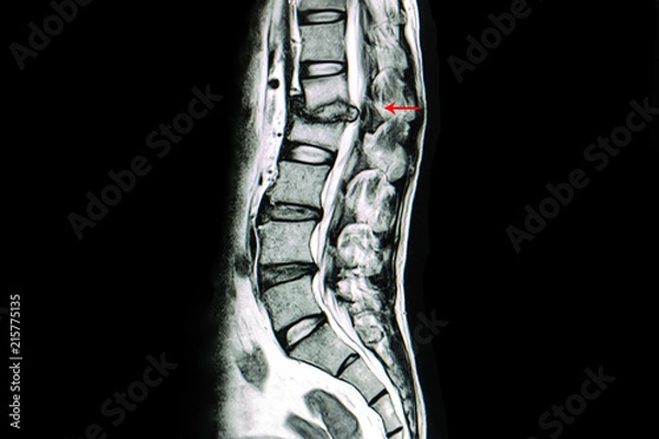 Fototapeta MRI scan of lumbar spines of a patient with kyphosis and back pain showing herniated disc from spondylodiscitis most likely from an infection such as staphylococci or mycobacteria.