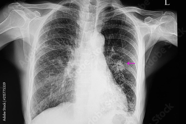 Fototapeta Chest xray of patient with pneumonia and lung nodule