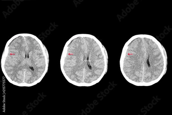 Obraz subdural hemorrhage and brain edema