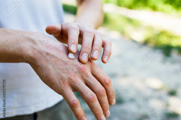 Fototapeta applying an cream emollient to dry flaky skin as in the treatment of psoriasis, eczema and other dry skin conditions