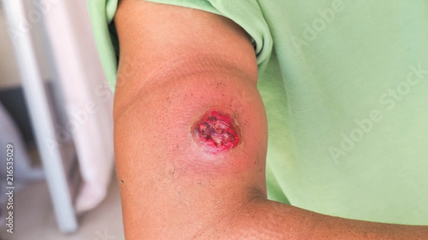Obraz upper arm with infection wound and abscess. 
