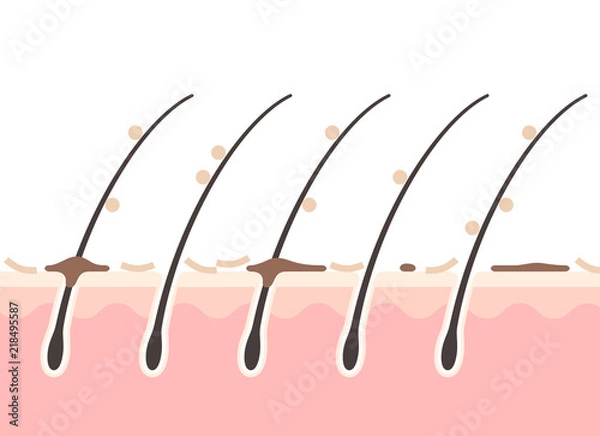 Obraz フケのある頭皮の断面図