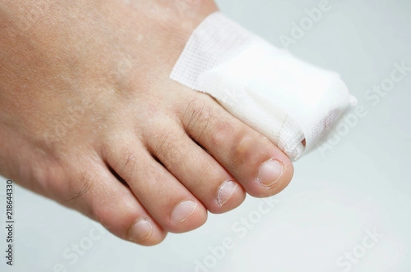 Fototapeta Duży paznokieć z opatrunkiem z gazy na białym tle
