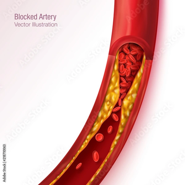 Obraz Blocked blood vessel - artery with cholesterol bulidup realistic vector illustration isolated background
