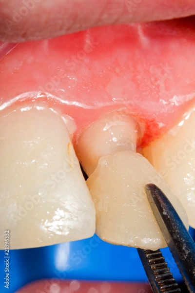 Fototapeta Temporary crown for tooth