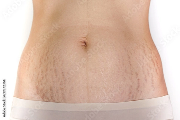 Fototapeta Abdominal scar marked pattern