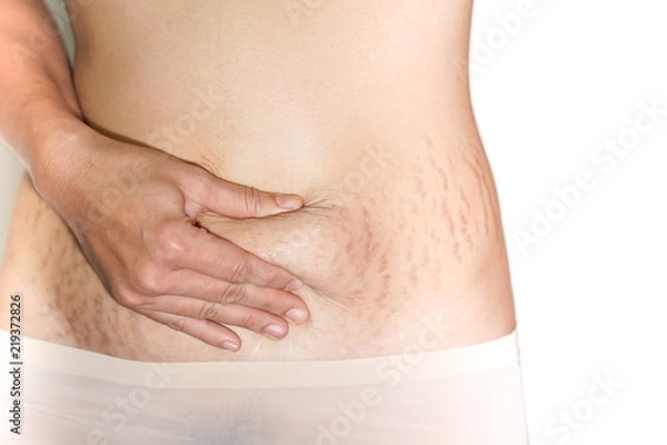 Obraz Abdominal scar marked pattern