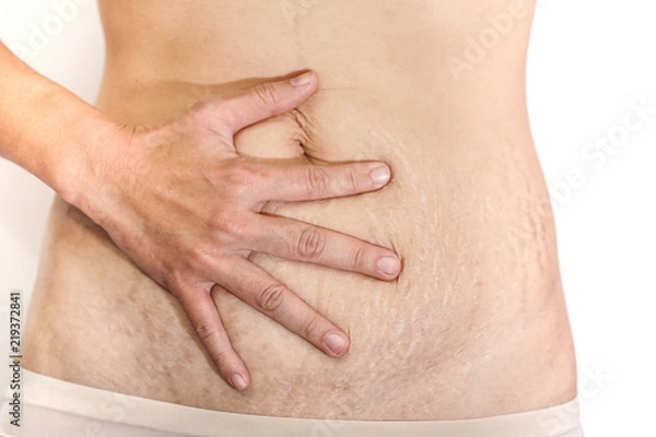 Fototapeta Abdominal scar marked pattern