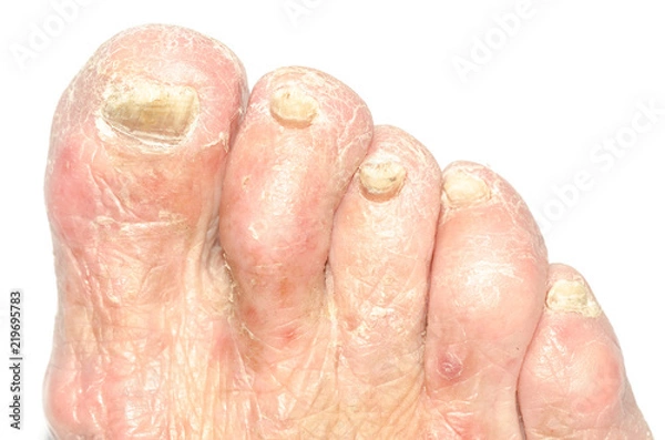 Fototapeta Toenail and foot fungus on a caucasian person isolated on white background