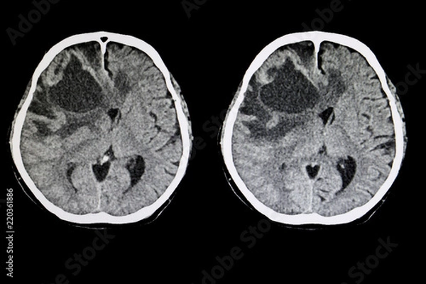 Obraz metastatic brain tumor