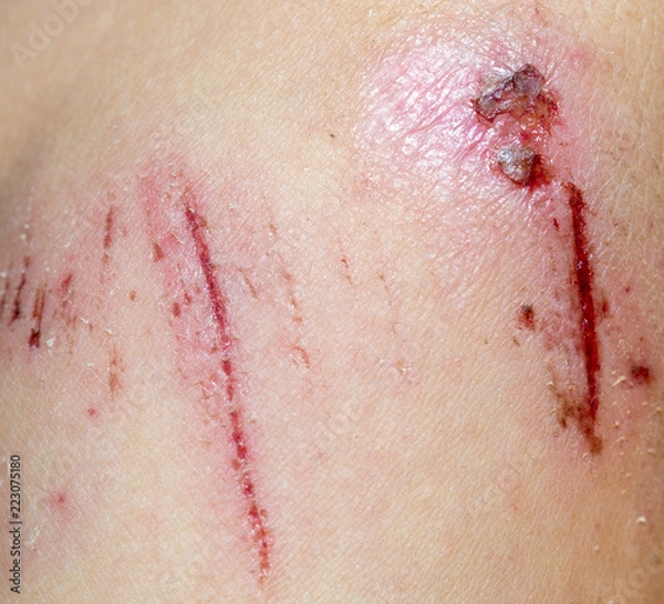 Obraz Wound on the skin of a macro