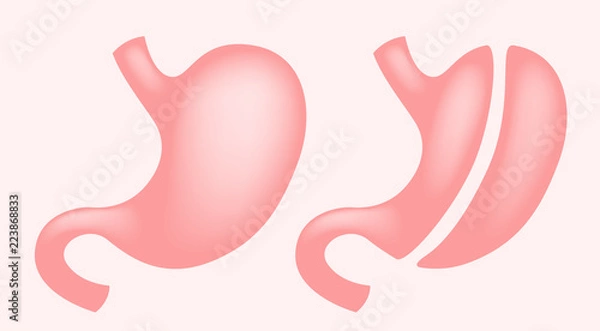 Obraz Laparoscopic Gastrectomy Gastric Sleeve / weight loss surgery vector