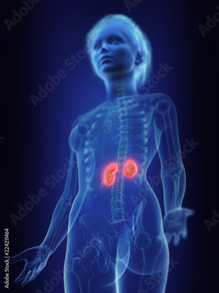 Fototapeta 3d rendered medically accurate illustration of an inflamed kidneys