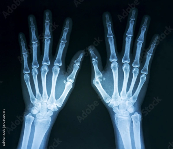 Obraz Film x-ray normal both human’s hands